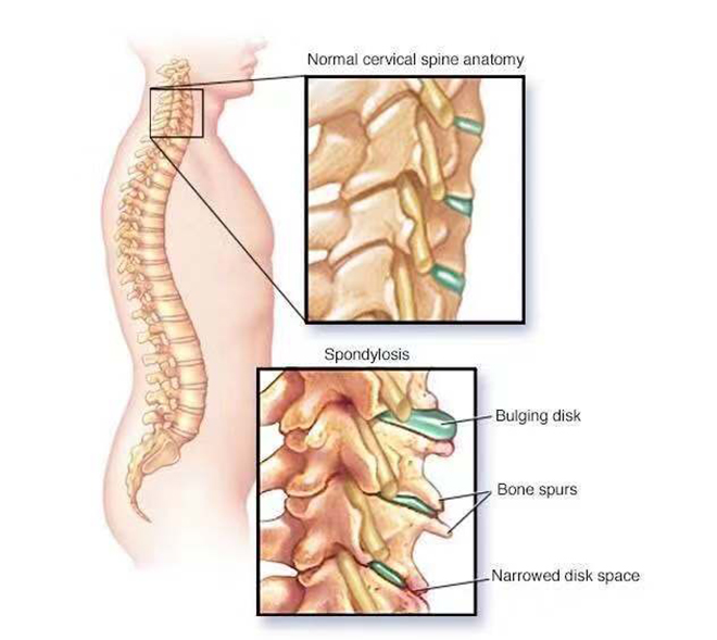 颈椎2.jpg 颈椎2.jpg